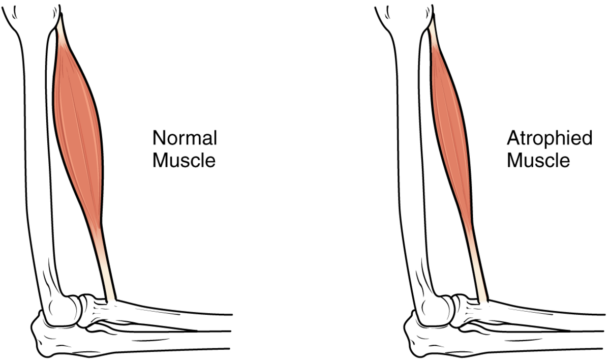 Diagram comparing a "Normal Muscle" to an "Atrophied Muscle" in a human arm. The normal muscle is depicted as larger and fuller, while the atrophied muscle is noticeably smaller and thinner, illustrating muscle wasting.
