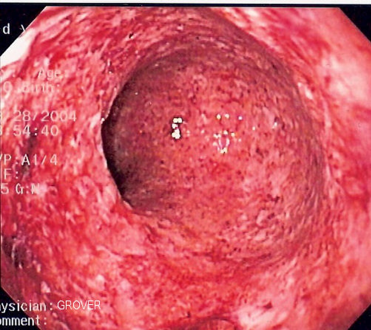 An endoscopic view of colitis, showing severe inflammation of the colon caused by Crohn's disease. The image displays a red, ulcerated, and granular mucosal surface within the colon.
