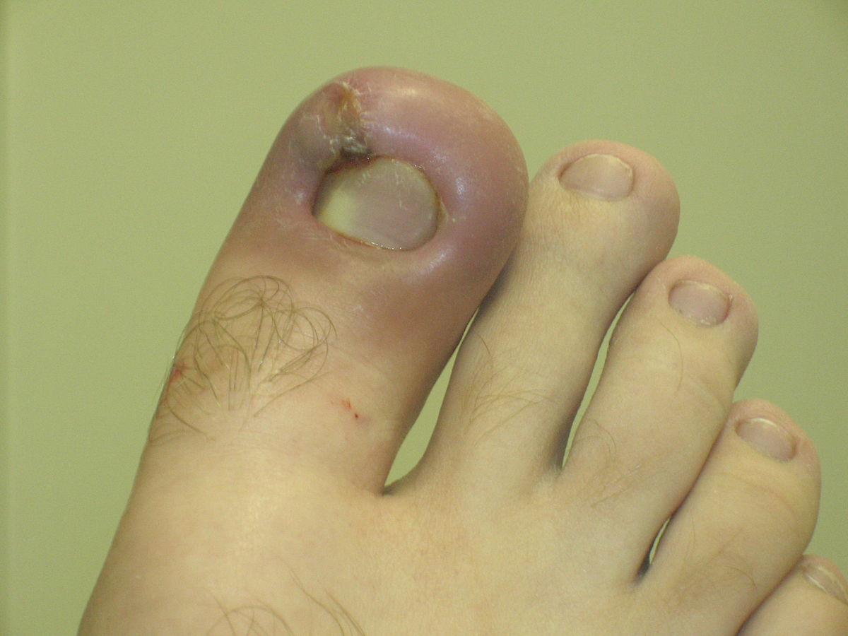 A close-up photograph of an infected ingrown toenail, displaying characteristic redness and swelling associated with acute inflammation. The skin around the toenail is visibly red and swollen.