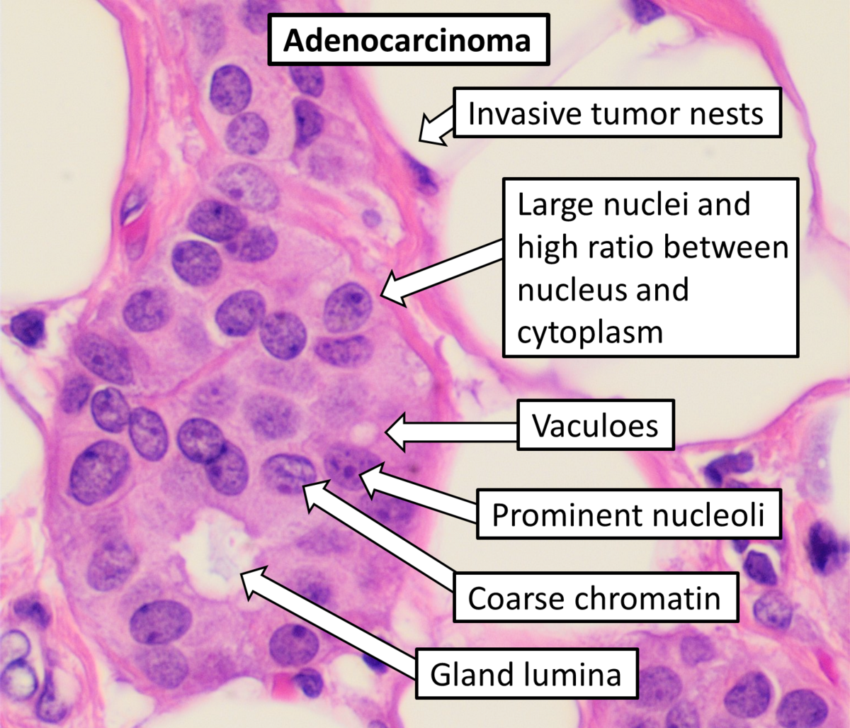 Histopathology of adenocarcinoma, showing microscopic features of cancer cells with annotations. Labels point to "Invasive tumor nests," "Large nuclei and high ratio between nucleus and cytoplasm," "Vacuoles," "Prominent nucleoli," "Coarse chromatin," and "Gland lumina."