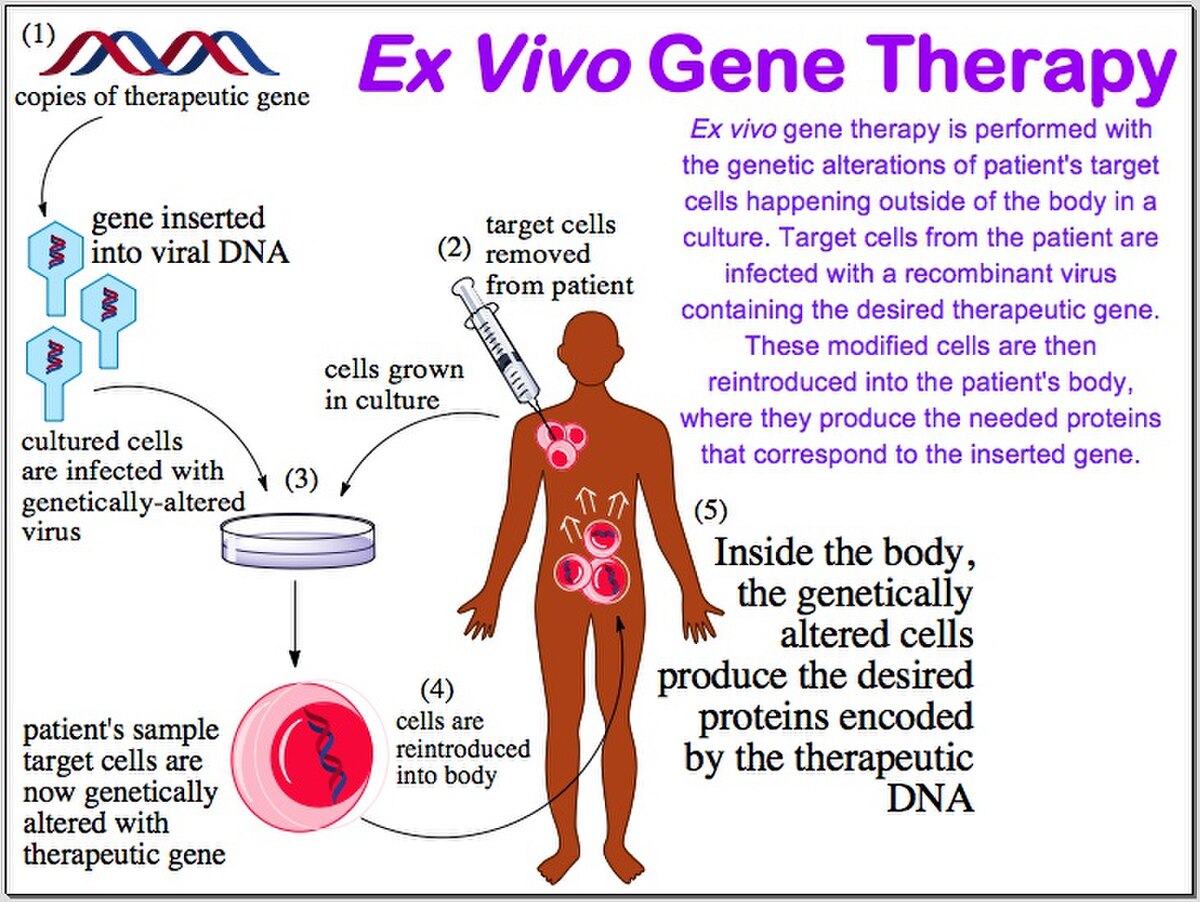 Diagram explaining Ex Vivo Gene Therapy, where target cells are removed from a patient, cultured, infected with a genetically-altered virus containing a therapeutic gene, and then reintroduced into the patient's body. The diagram shows copies of a therapeutic gene, gene inserted into viral DNA, target cells removed from patient, cells grown in culture, cultured cells infected with genetically-altered virus, cells reintroduced into body, and inside the body, genetically altered cells produce desired proteins.