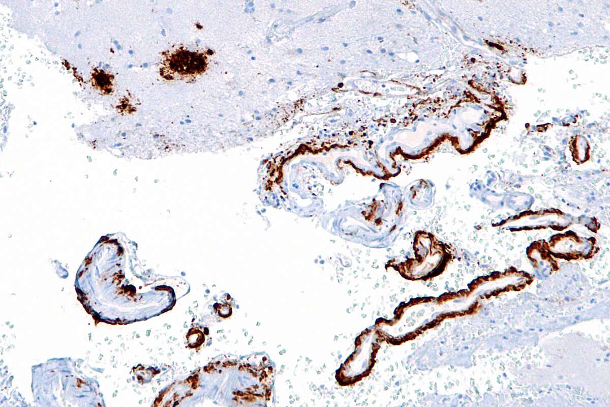 Micrograph showing amyloid beta (brown) in amyloid plaques of the cerebral cortex (upper left) and cerebral blood vessels (right) with immunostaining. The brown staining highlights the presence of amyloid beta deposits within brain tissue and vascular structures.