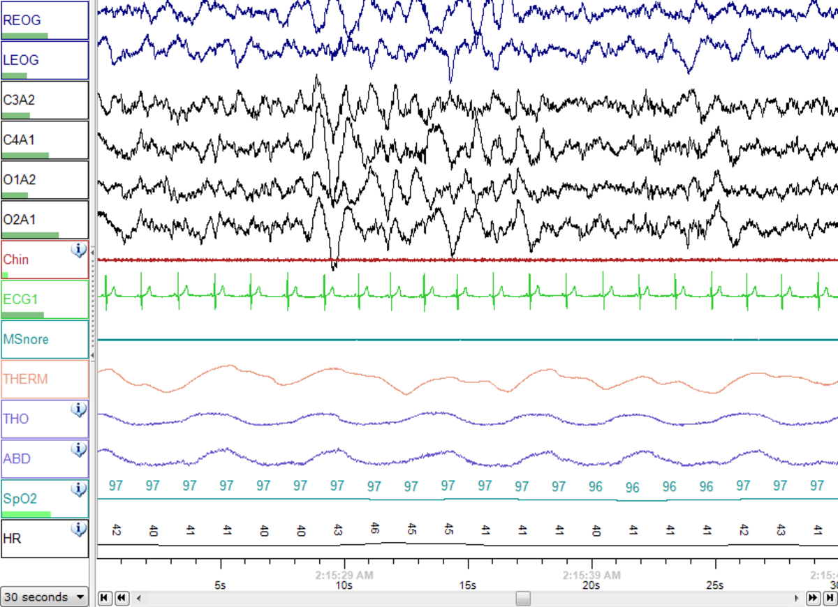 A polysomnography (PSG) recording displays multiple physiological signals over a 30-second period, indicating Sleep Stage N3. Labeled channels include REOG, LEOG, C3A2, C4A1, O1A2, O2A1, Chin, ECG1, MSnore, THERM, THO, ABD, SpO2, and HR, showing brain waves, eye movements, muscle activity, heart rate, snoring, temperature, and respiratory effort.