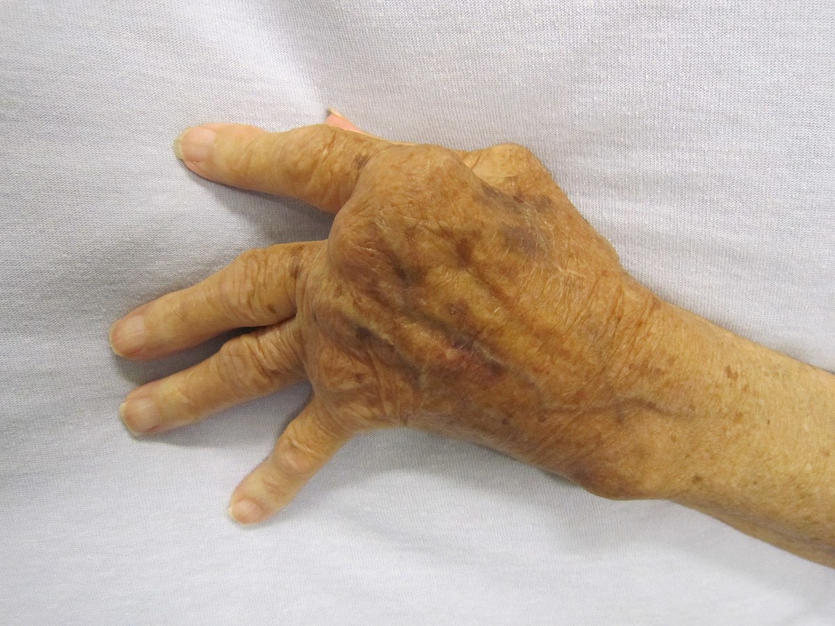 Close-up photograph of a human hand showing severe swelling and deformation of the joints, characteristic of rheumatoid arthritis.