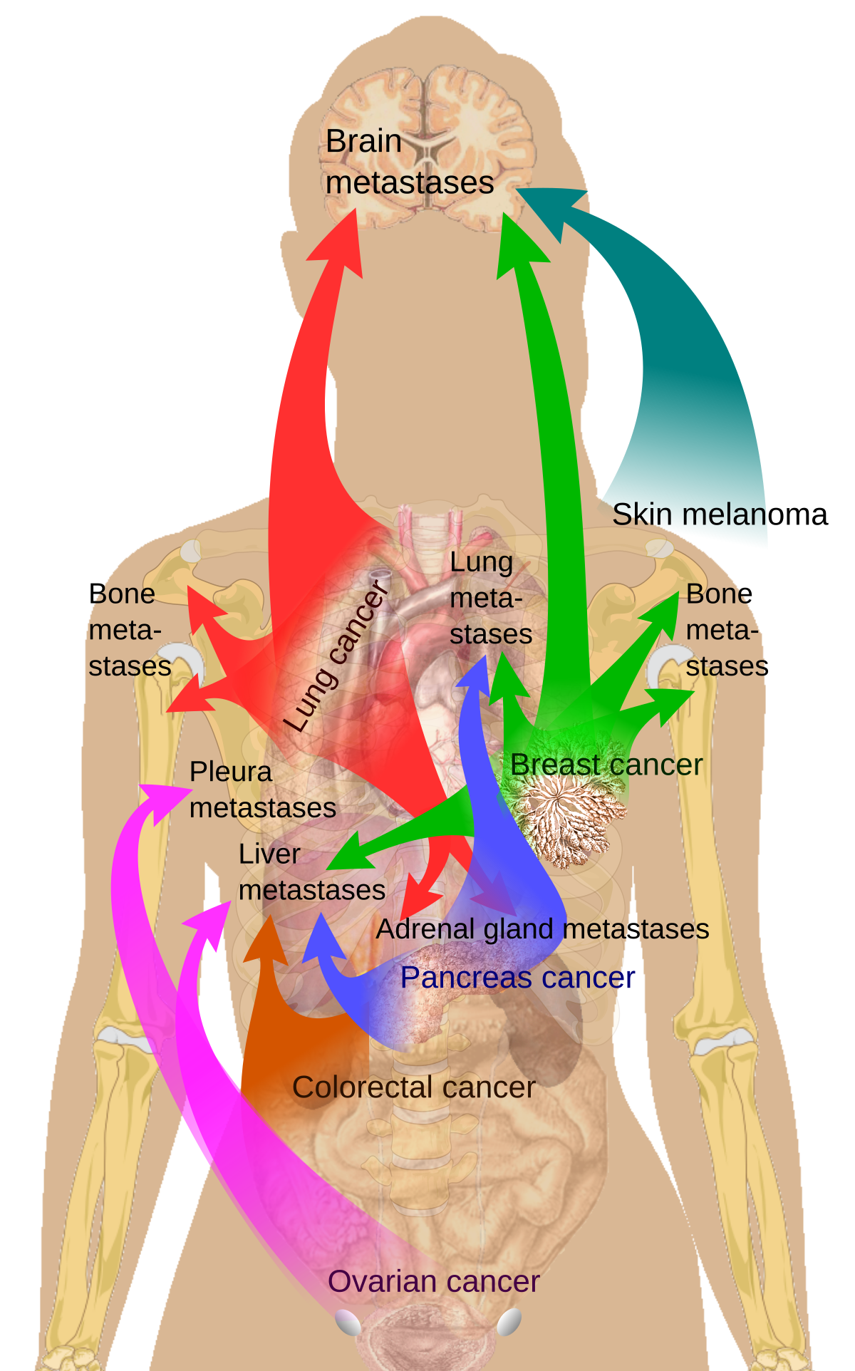 Diagram illustrating common sites of metastasis for various cancers within the human body. Arrows indicate the spread from primary cancers such as lung cancer, breast cancer, skin melanoma, colorectal cancer, pancreas cancer, and ovarian cancer to secondary sites like brain, bone, lung, pleura, liver, and adrenal gland.