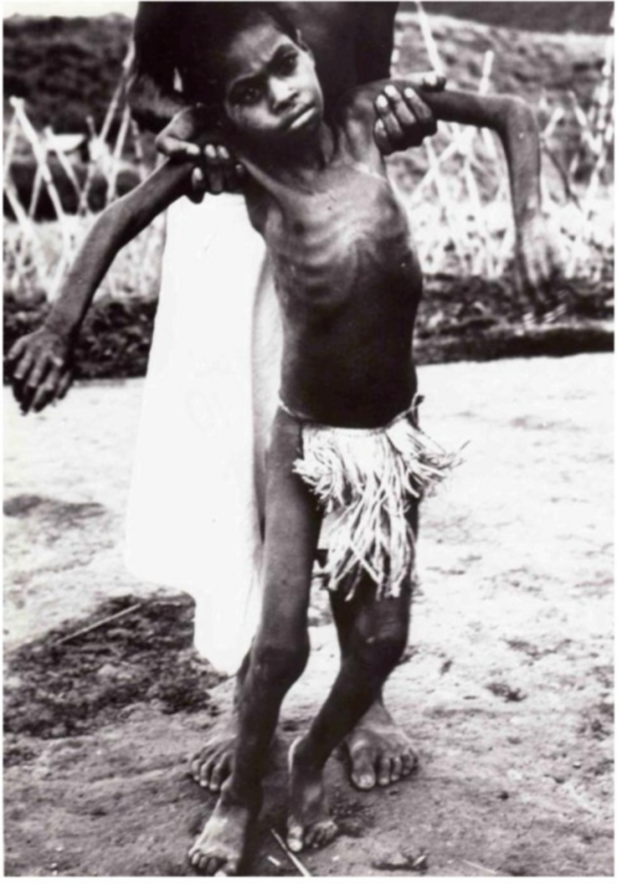 A Fore child in an advanced stage of kuru is supported by an adult, showing severe emaciation and muscle wasting. The child is wearing a grass skirt and appears to have difficulty standing independently.