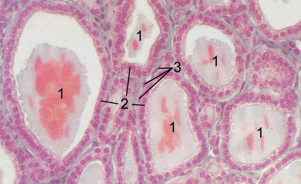 Microscopic image of a section of a thyroid gland, showing multiple follicles. Labeled components include "1" for colloid, "2" for follicular cells, and "3" for endothelial cells.