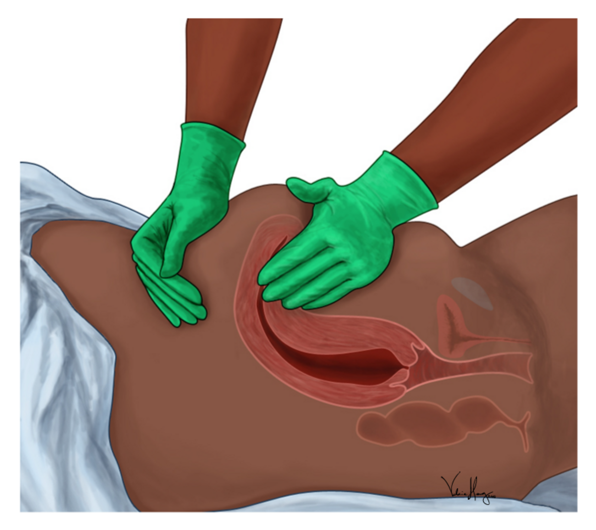 An illustration depicting a side view of a uterine massage, showing gloved hands applying pressure to the abdomen with the internal anatomy of the uterus and surrounding organs visible. The uterus is shown as a red, muscular organ within the pelvic cavity.