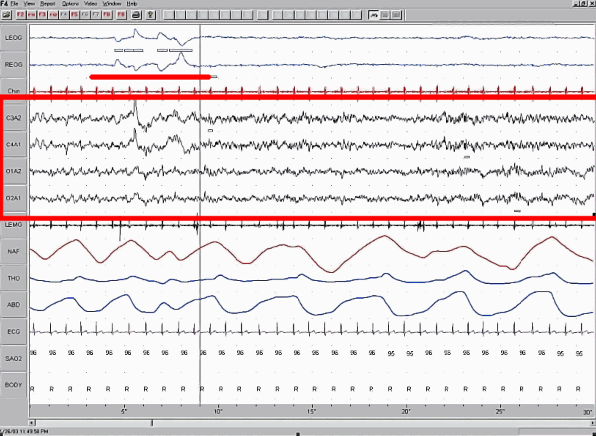 A polysomnographic record of REM sleep, displaying multiple physiological measurements over time. The electroencephalogram (EEG) is highlighted by a red box, and eye movement is highlighted by a red line.
