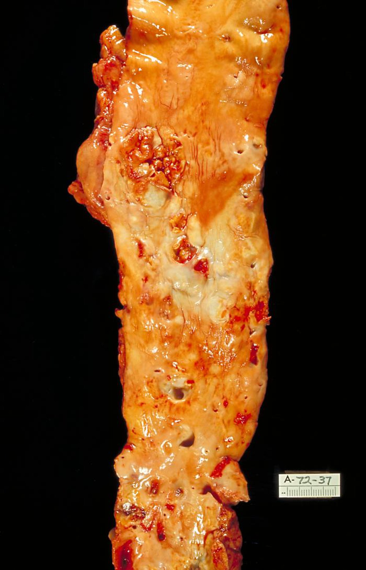 Gross pathology specimen of a human aorta showing severe atherosclerosis. The inner surface of the aorta is irregular, discolored, and has numerous raised, yellowish-white plaques and ulcerations, with a label "A-72-37" in the bottom right corner.