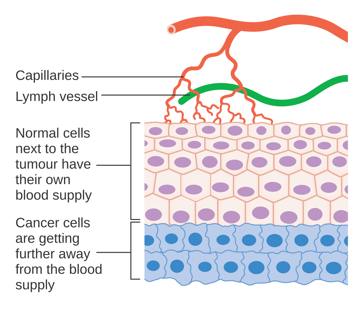Diagram illustrating why cancer cells need their own blood supply, showing a cross-section of tissue with normal cells and cancer cells. Capillaries and lymph vessels are shown branching into the normal tissue, while cancer cells are depicted further away from the existing blood supply.
