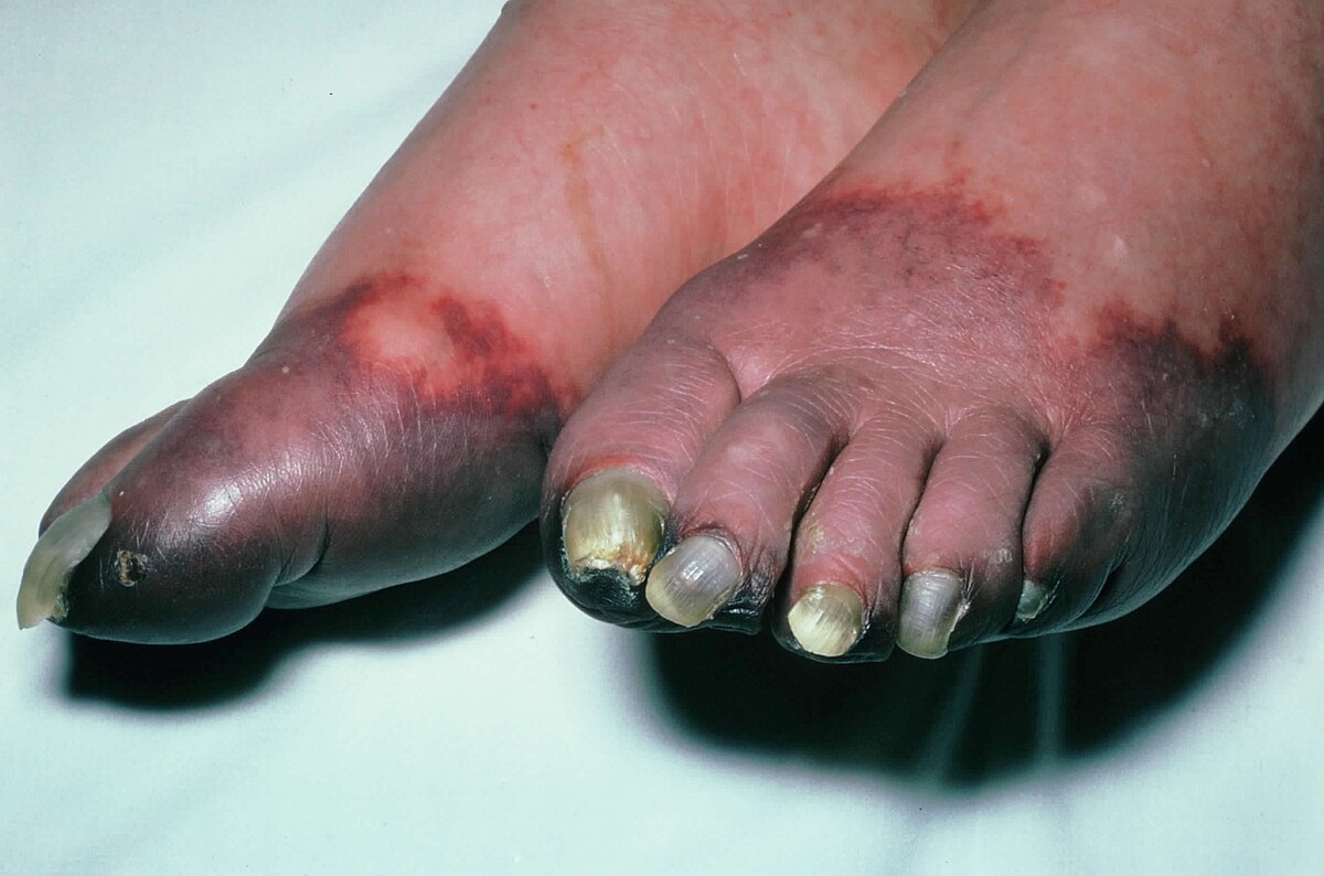 Close-up photograph of gangrenous toes on both feet of a diabetic patient. The toes appear discolored, dark purple to black, with some toenails showing fungal infection, indicating severe tissue necrosis.