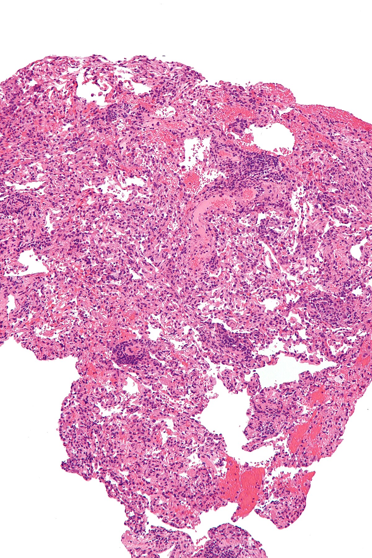 A micrograph showing lung transplant rejection, with a lung biopsy stained with H&E. The tissue displays diffuse pink and purple cellular infiltration, indicating inflammation and rejection.
