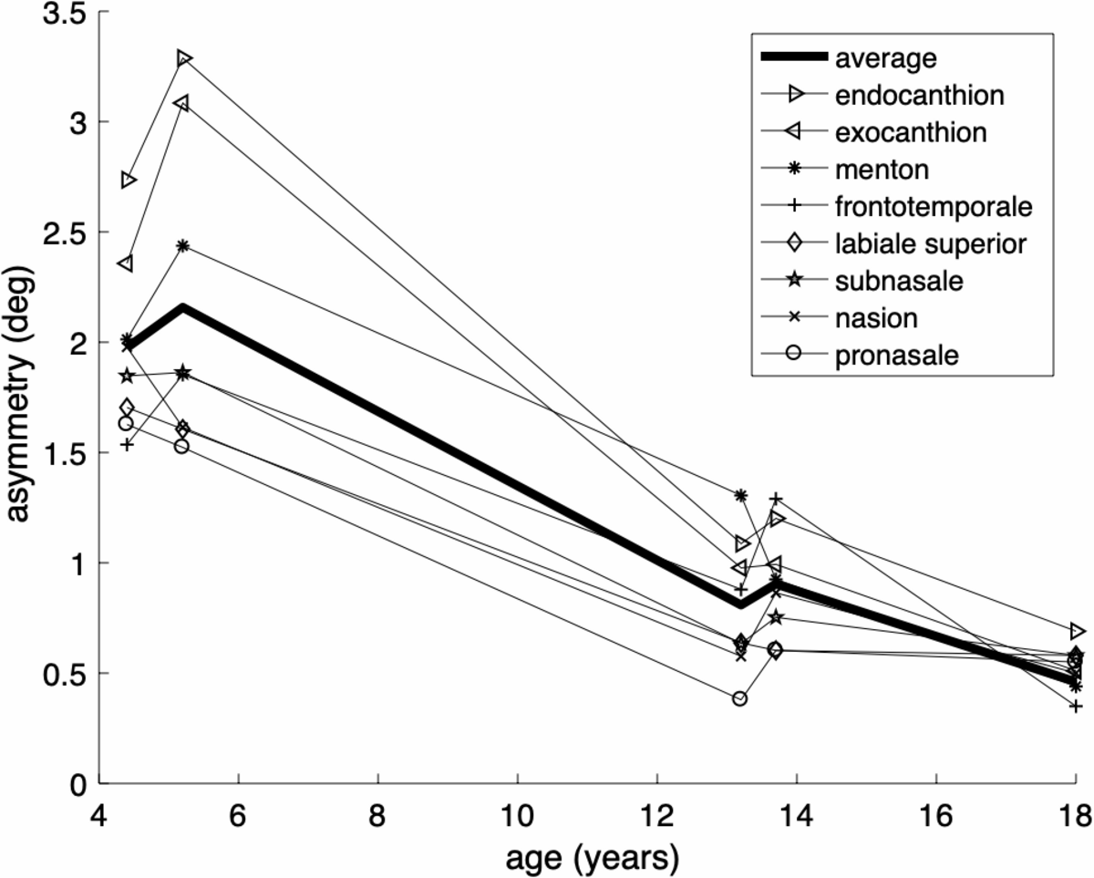 Graph plotting the gradual decrease of aurofacial asymmetry in degrees (Y-axis) with age in years (X-axis) from 4 to 18 years. Multiple lines represent different facial landmarks including endocanthion, exocanthion, menton, frontotemporale, labiale superior, subnasale, nasion, and pronasale, with a thick black line showing the average asymmetry.