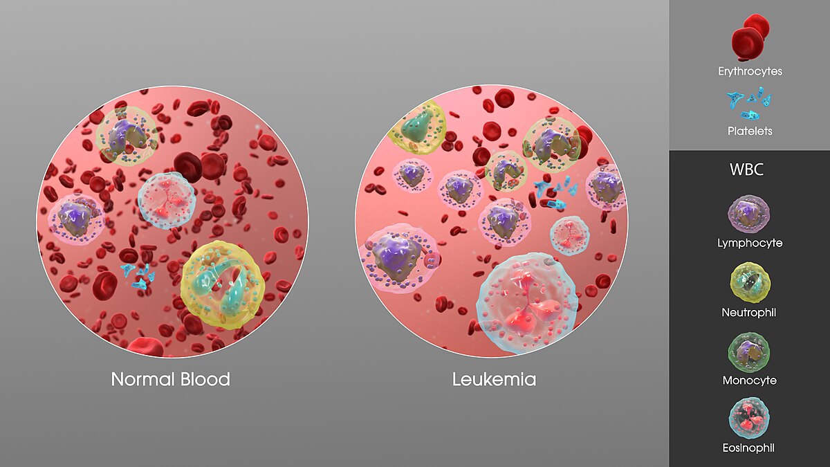 Diagram comparing normal blood with blood affected by leukemia, showing the increase in white blood cells. The "Normal Blood" panel shows a balanced distribution of "Erythrocytes", "Platelets", and various "WBC" types (Lymphocyte, Neutrophil, Monocyte, Eosinophil), while the "Leukemia" panel shows a significantly higher concentration of abnormal white blood cells.