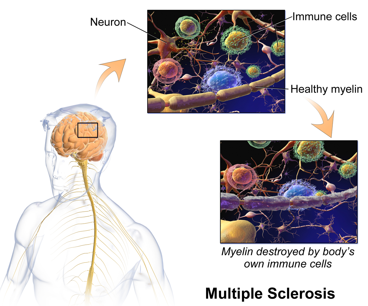 A diagram illustrating the pathology of Multiple Sclerosis, showing a healthy neuron with intact myelin and immune cells, contrasted with a neuron where myelin is destroyed by the body's own immune cells. The diagram includes an overview of a human brain and spinal cord, with a magnified section indicating the area of cellular detail.