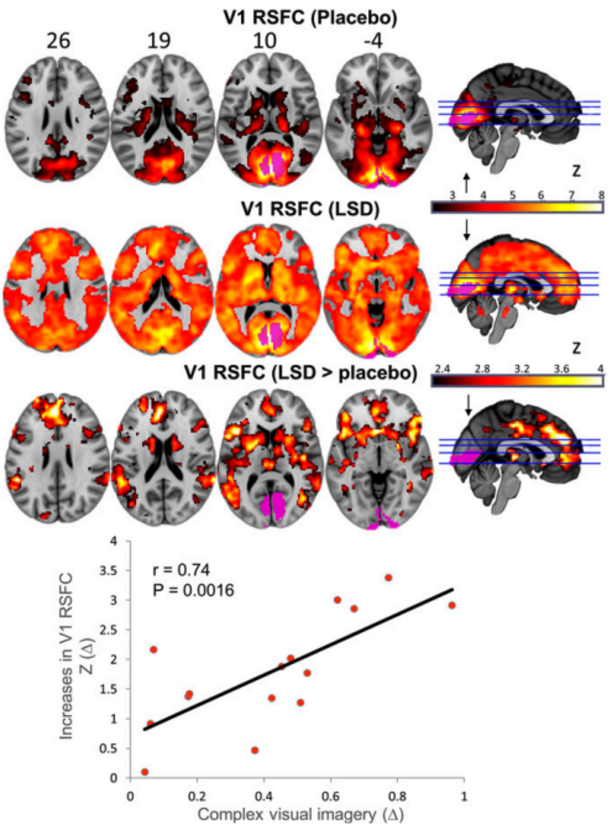 fMRI brain scans illustrating changes in V1 RSFC (primary visual cortex resting-state functional connectivity) under placebo and LSD conditions, and the difference between them. The top row shows V1 RSFC (Placebo) with Z-scores ranging from 26 to -4, the middle row shows V1 RSFC (LSD), and the bottom row shows V1 RSFC (LSD > placebo) with a color scale from 2.4 to 4. The scatter plot below shows increases in V1 RSFC Z(Δ) versus Complex visual imagery (Δ), with a correlation coefficient r = 0.74 and P = 0.0016.
