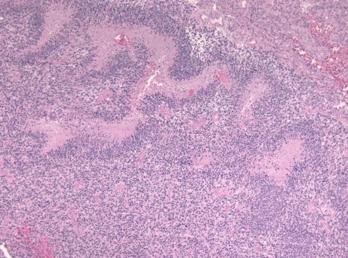 Histopathology image showing pseudopalisading necrosis in a glioblastoma multiforme (GBM), characterized by a swirling pattern of viable tumor cells surrounding areas of central necrosis. The pink-stained necrotic regions are surrounded by densely packed, purple-stained tumor cells.