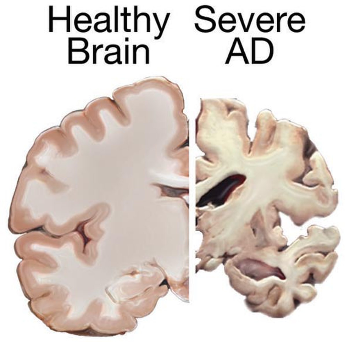 Comparison of a healthy brain (left) and a brain with severe Alzheimer's disease (right), showing significant atrophy and enlarged ventricles in the diseased brain.