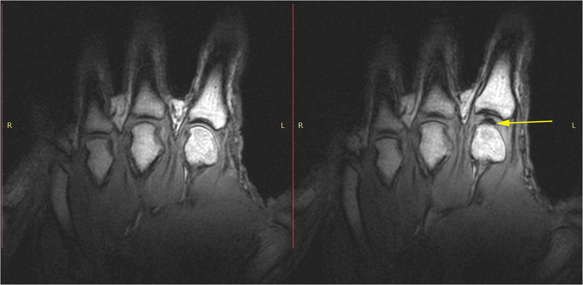 MRI images of a hand before and after joint cracking, showing the visualization of joint cavitation. The left image shows the hand in a resting phase, while the right image, taken after cracking and with a post-cracking distraction force, reveals a dark, interarticular void indicated by a yellow arrow.
