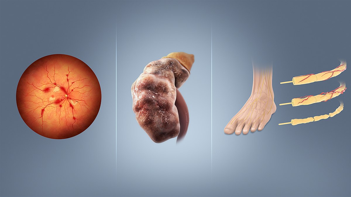 Three illustrations showing potential complications of diabetes: retinopathy (left, an eye with damaged blood vessels), nephropathy (center, a diseased kidney), and neuropathy (right, damaged nerves in a foot and magnified nerve fibers).