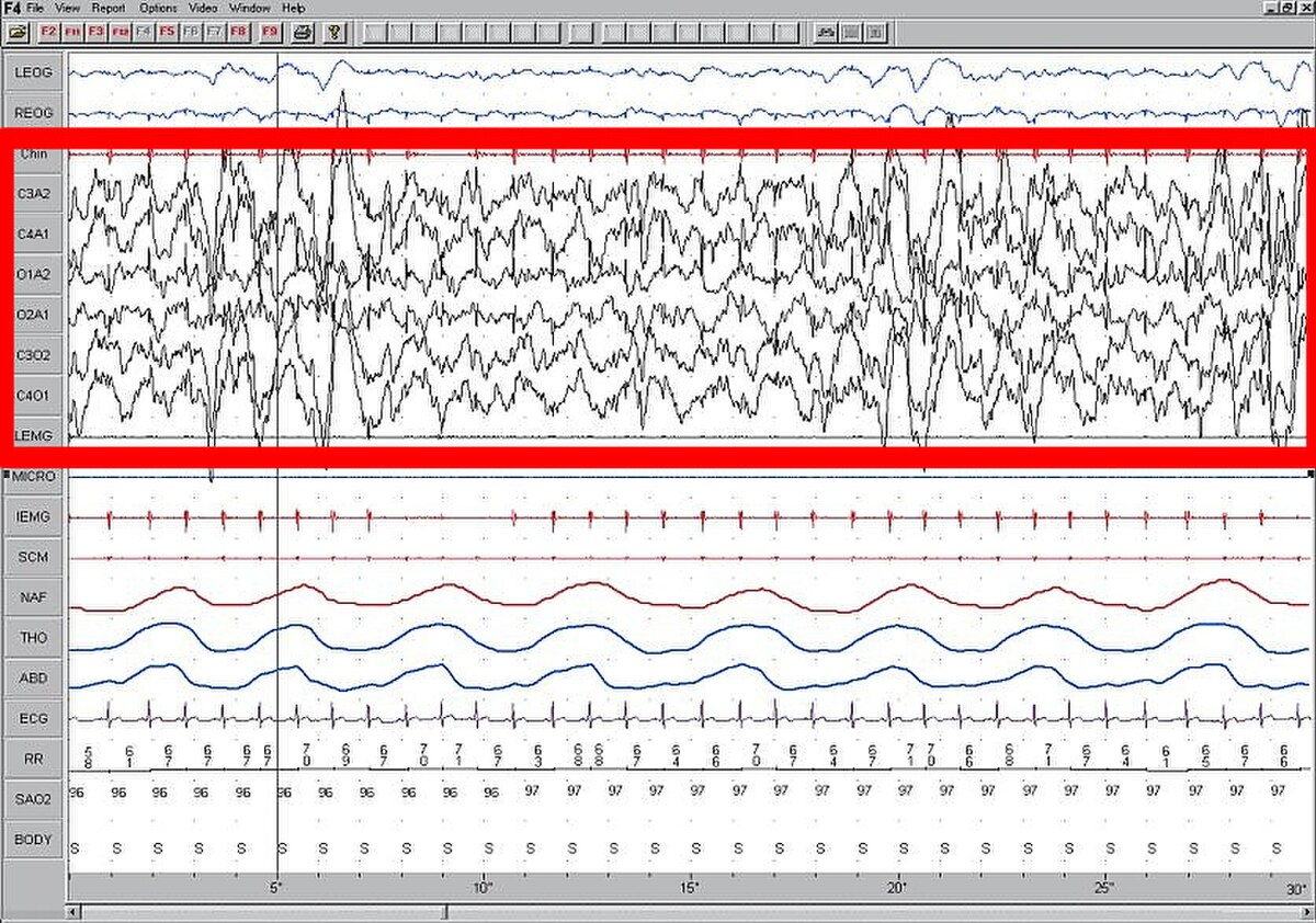 A polysomnogram displays brain wave activity during Stage 4 slow-wave sleep, with high-amplitude EEG highlighted in red. The top section shows various EEG leads (F3-A2, C3-A2, O1-A2, F4-A1, C4-A1, O2-A1, EMG) with the highlighted section showing large, slow waves, while the bottom section shows other physiological measurements (EOG, ECG, airflow, body position).