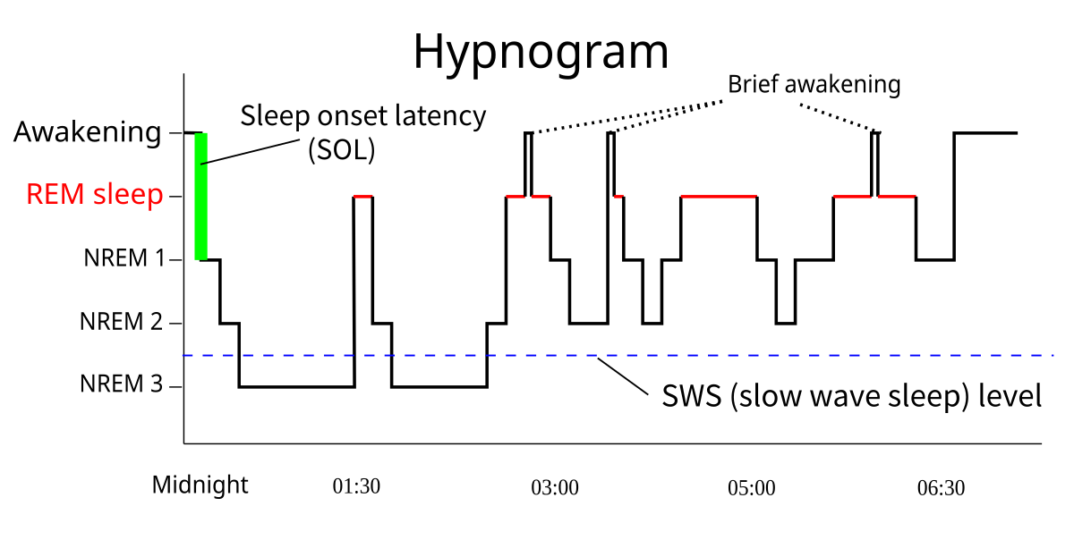 Hypnogram showing sleep stages over time, plotting sleep onset latency (SOL), REM sleep, NREM 1, NREM 2, NREM 3, and brief awakenings. The SWS (slow wave sleep) level is indicated by a dashed blue line.