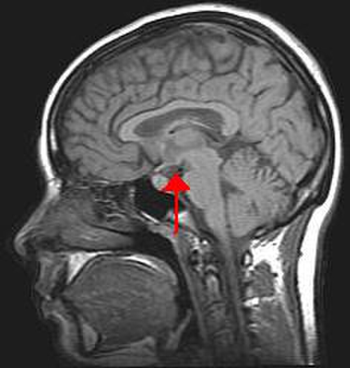 A sagittal MRI scan of a human head highlights the hypothalamus with a red arrow. The image shows the brain, cerebellum, brainstem, and nasal cavity in profile.