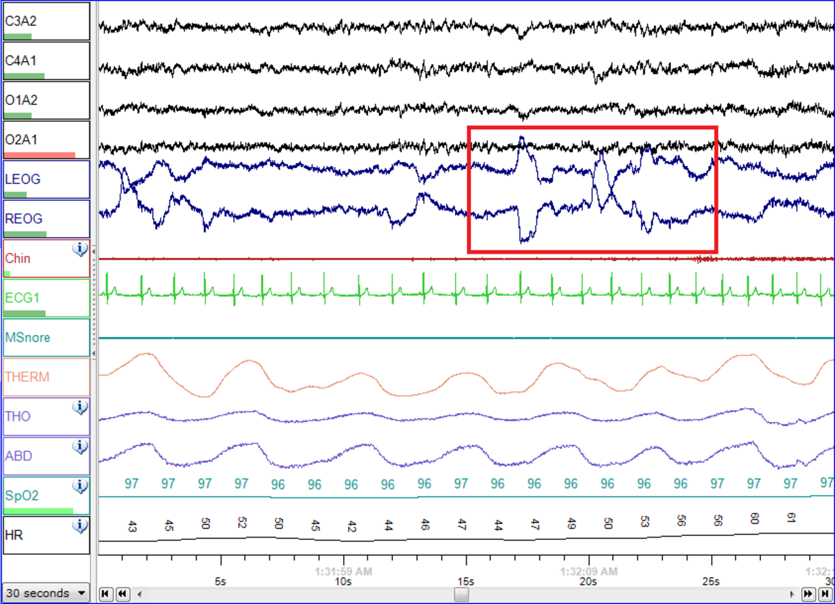 A polysomnography (PSG) recording displaying multiple physiological signals during REM sleep, including EEG (C3A2, C4A1, O1A2, O2A1), EOG (LEOG, REOG), EMG (Chin), ECG (EOG1), and respiratory measurements (MSnore, THERM, THO, ABD, SpO2, HR). A red box highlights rapid eye movements in the EOG channels, characteristic of REM sleep.