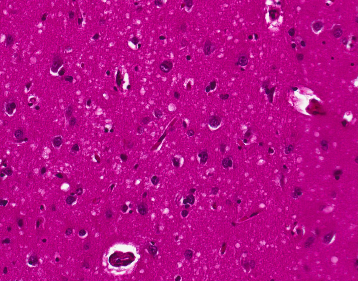 A microscopic image shows brain tissue with spongiform change, characterized by numerous small vacuoles (holes) and some elongated structures, indicative of Creutzfeldt-Jakob disease.
