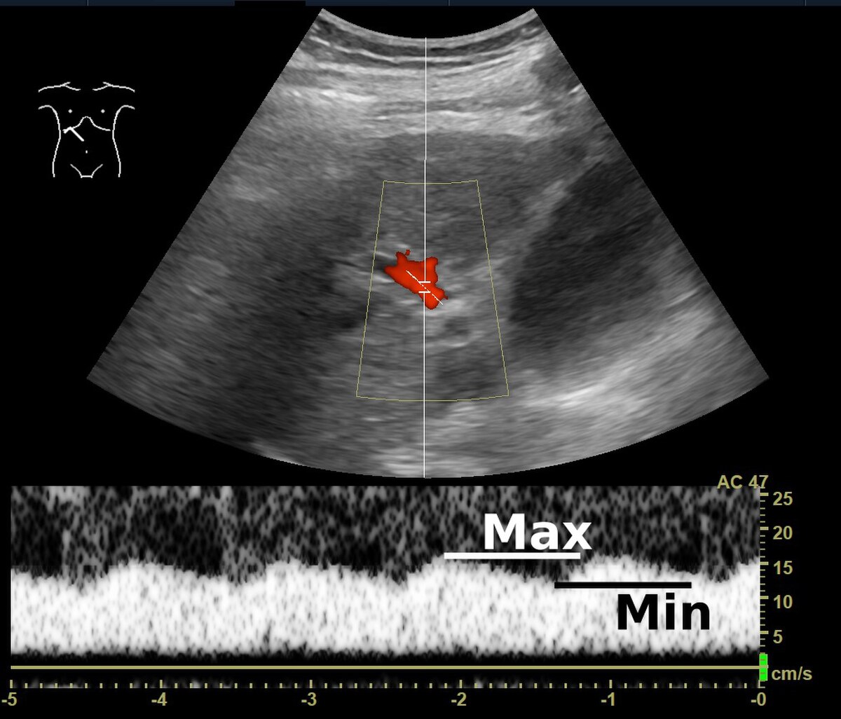 A Doppler ultrasonography image of the portal vein, displaying blood flow velocity over a 5-second period. The graph at the bottom shows velocity in cm/s on the Y-axis and time in seconds on the X-axis, with peaks marked "Max" and troughs marked "Min."