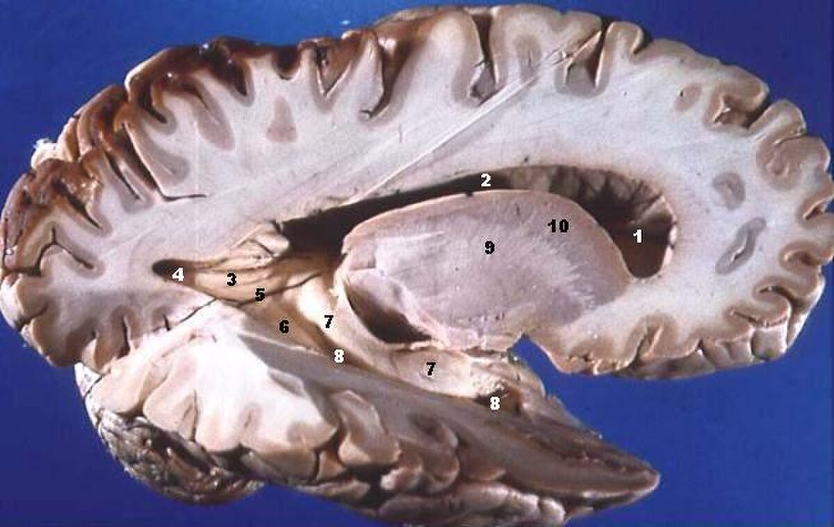 A dissected human brain in a lateral view shows the distinct grey matter and white matter, with various regions numbered from 1 to 10.