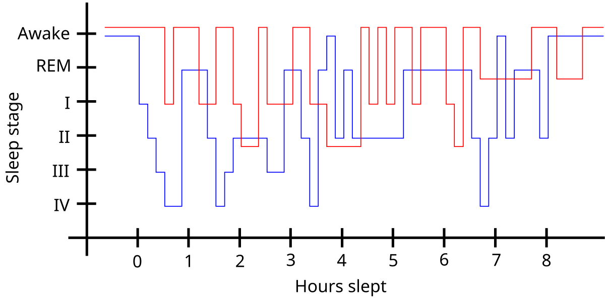 Graph comparing sleep patterns, with Sleep stage on the Y-axis (Awake, REM, I, II, III, IV) and Hours slept on the X-axis (0 to 8.5 hours). The red line represents a typical sleep pattern, while the blue line illustrates a disrupted sleep pattern, likely associated with restless legs syndrome, showing more frequent awakenings and shifts between sleep stages.