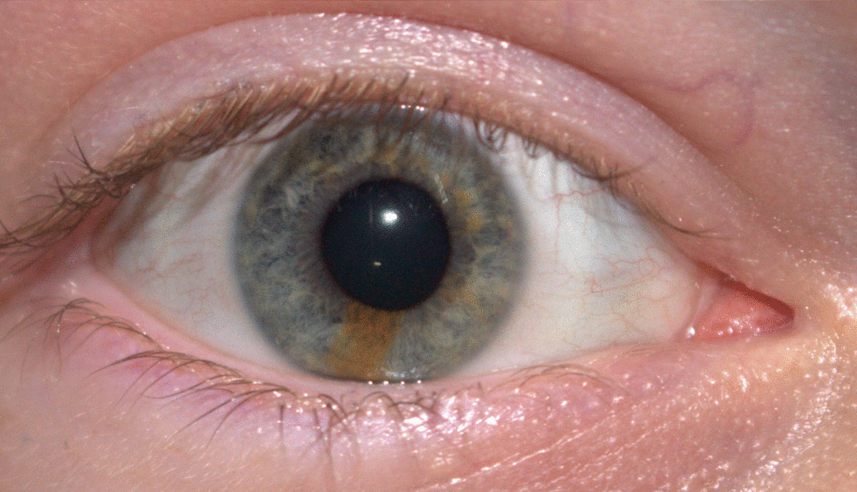 A montage of five pictures of a male subject's right eye demonstrating torsional eye movement, with partial heterochromia visible in the iris. The eye rotates slightly, showing the subtle movement of the pupil and iris.