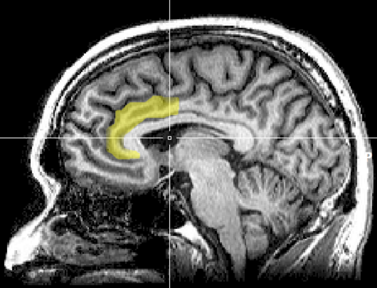 MRI scan of a human brain in sagittal view, highlighting the anterior cingulate cortex in yellow. A white crosshair indicates a specific point within the brain structure.