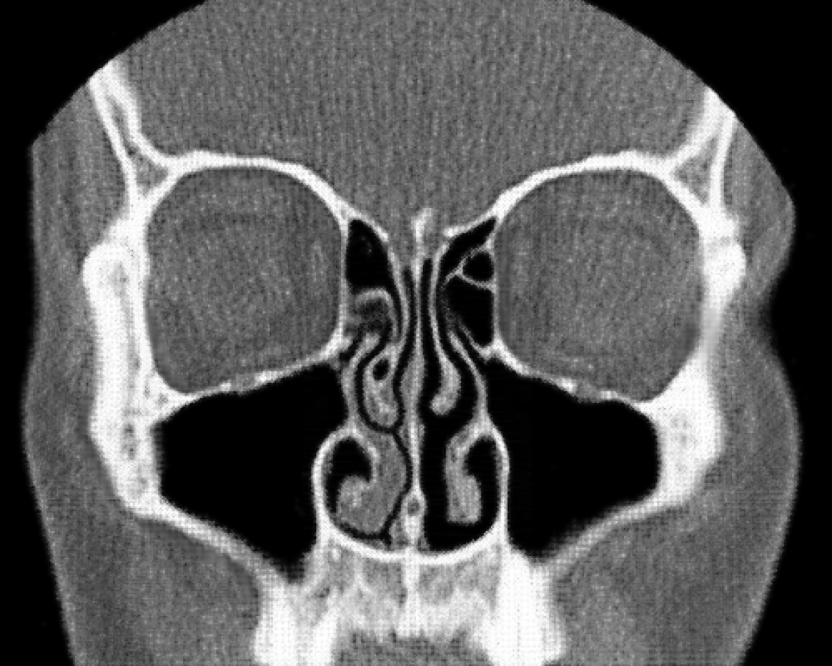 A CT scan of the human nasal cavity, showing evidence of the nasal cycle with the right airway appearing more open and the left turbinates appearing swollen.