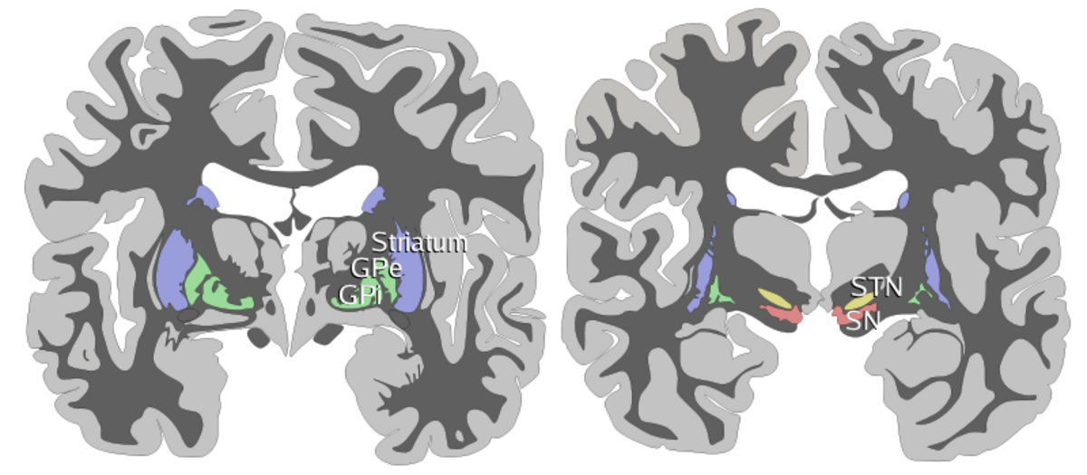 Coronal slices of the human brain showing the basal ganglia, with white matter in dark gray and gray matter in light gray. The anterior slice labels the Striatum, globus pallidus external (GPe), and globus pallidus internal (GPi). The posterior slice labels the subthalamic nucleus (STN) and substantia nigra (SN).
