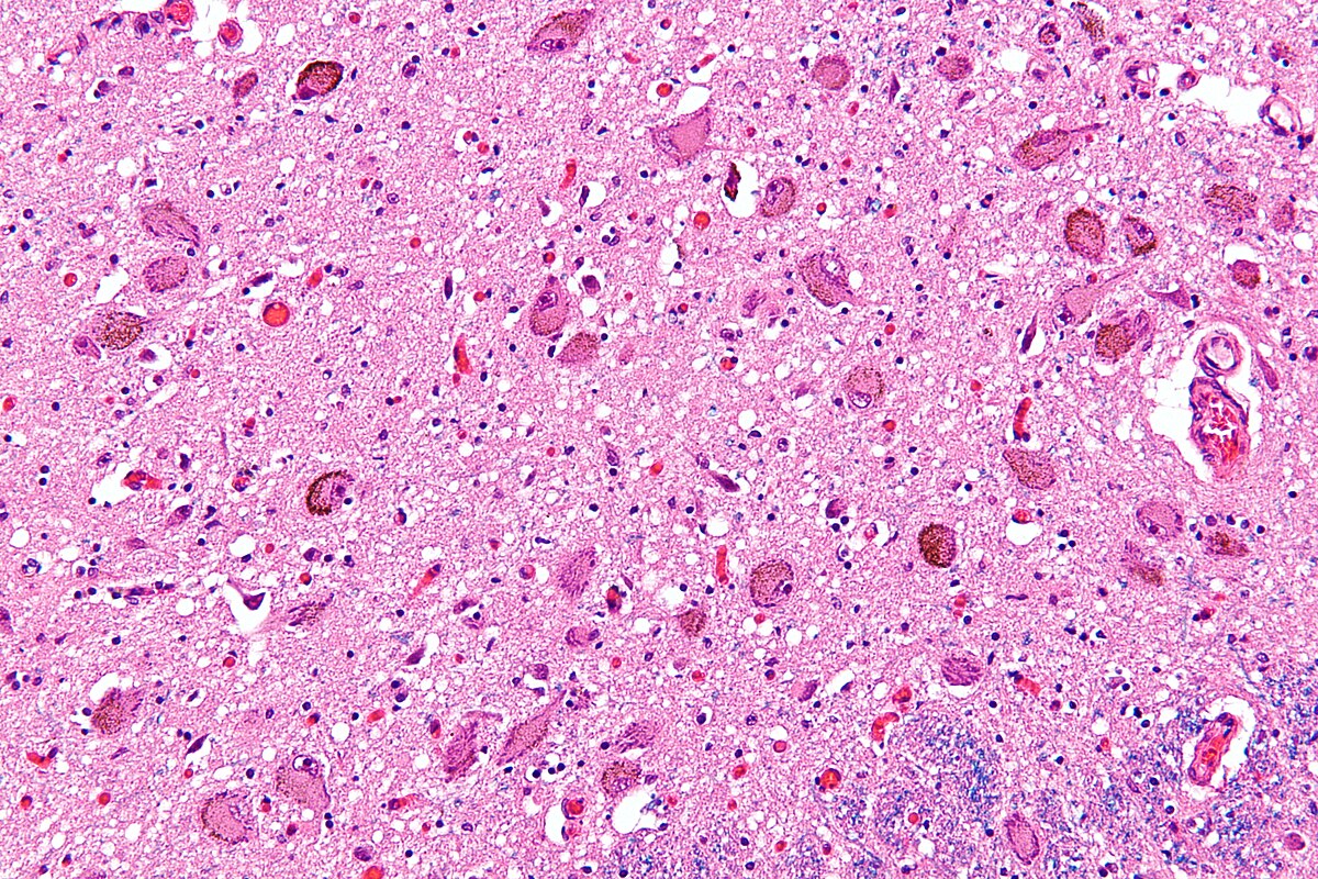 High magnification micrograph showing the locus coeruleus, stained with HE-LFB. The image displays numerous large, pigmented neurons (neuromelanin) scattered within a pinkish-purple neuropil, characteristic of this brain region.