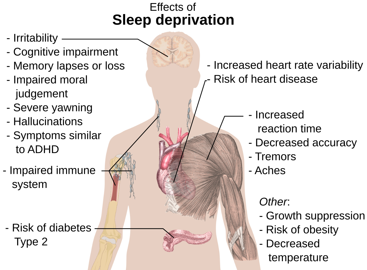 Diagram illustrating the main health effects of sleep deprivation on the human body. Effects include irritability, cognitive impairment, memory lapses, impaired moral judgment, severe yawning, hallucinations, symptoms similar to ADHD, impaired immune system, risk of diabetes Type 2, increased heart rate variability, risk of heart disease, increased reaction time, decreased accuracy, tremors, aches, growth suppression, risk of obesity, and decreased temperature.